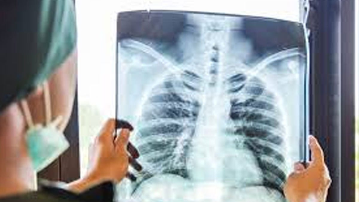 Maharashtra Starts 1HP To Prevent TB In People Living With HIV
